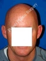 Ear Surgery (Otoplasty) 616613
