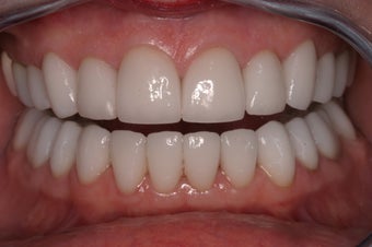 Full Mouth Reconstruction after 329922