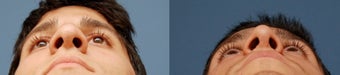 Rhinoplasty, Ethnic Iranian 346238