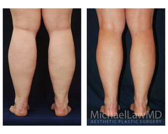 Liposuction 397064