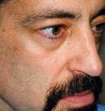 Mid facelift with tear trough implant before 87079