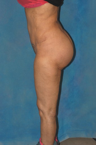 Women's Buttocks Augmentation after 518128