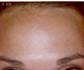 Botox after 469290