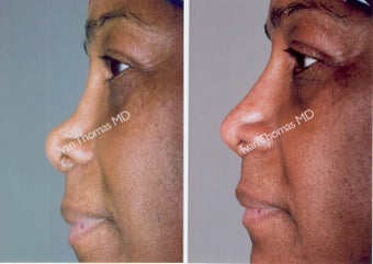 Non-Surgical Rhinoplasty before 243652
