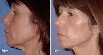 Threadlift for neck and jaw definition before 6820