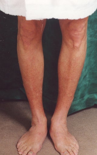 Men's Calf Augmentation 519059