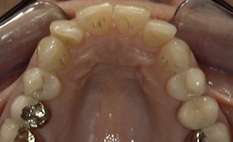 Invisalign: dramatic rotation of front teeth before 275754