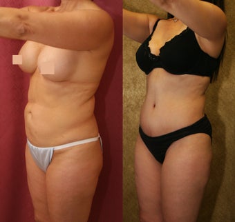 tummy tuck after 304698