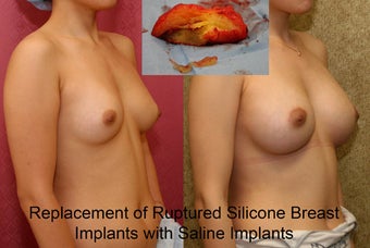 breast implants revision after 302665