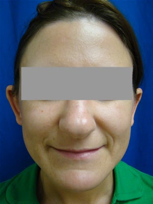 Ear Surgery (Otoplasty) before 128113