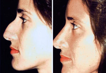 38 year old female, rhinoplasty before 629107