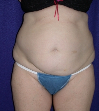 Tummy Tuck (abdominoplasty) before 208467