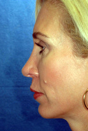 Chin Implant and Rhinoplasty after 324981