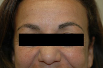 Permanent Makeup Removal Los Angeles Before and After Pictures after 641717