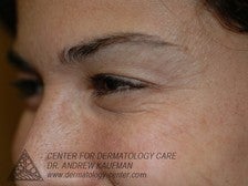 Botox to Periorbital Wrinkles (Crows' Feet) after 315093