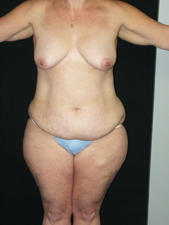 Belt Lipectomy before 379797
