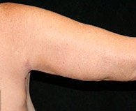 Arm Lift after 608970