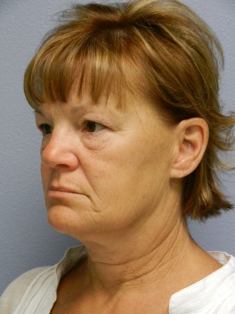 Lower Face with Neck Lift 574623