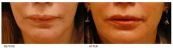 Lip Reduction/Lip Correction before 136726