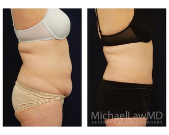 Abdominoplasty - Tummy Tuck 396085
