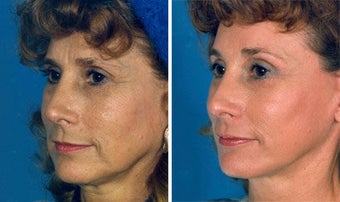 Cheek Lift and Augmentation before 296650