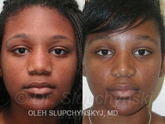 African American Rhinoplasty 374013
