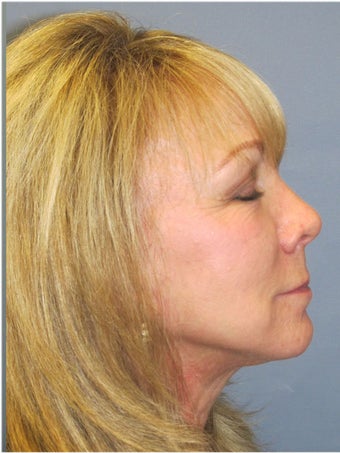 Obagi Blue Peel 635079