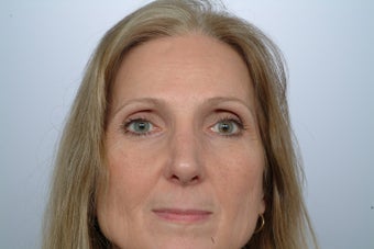 Revision Rhinoplasty after 358580