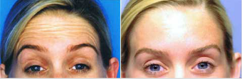 Botox before 575408