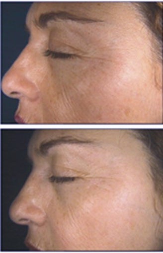 IPL for Freckles and Age Spots before 6364