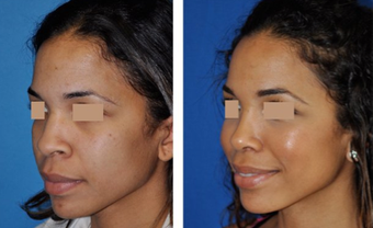 Rhinoplasty before 293540