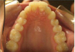 Invisalign 24 Months Severe Over Jet and Tongue Thrust before 349090