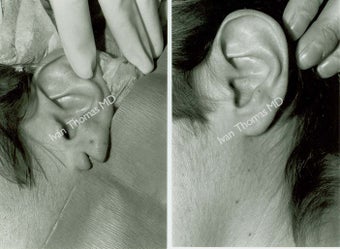Earlobe Surgery before 243311