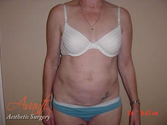Body Jet after 379521