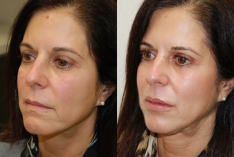 Lip Augmentation with Silikon-1000. 2 treatments. before 430186