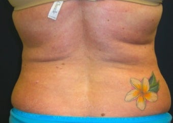 Lipo for back before 374829