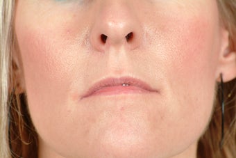 Restylane before 323688