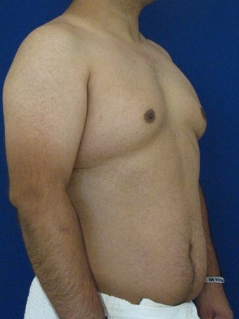 Vaser Hi-Def Liposuction of abdomen, chest, back and flanks 422693
