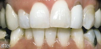 Teeth Whitening Smoking after 234630