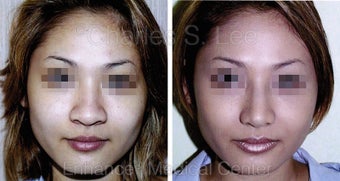 Nose before 431406