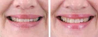 Botox for wrinkles before 6322