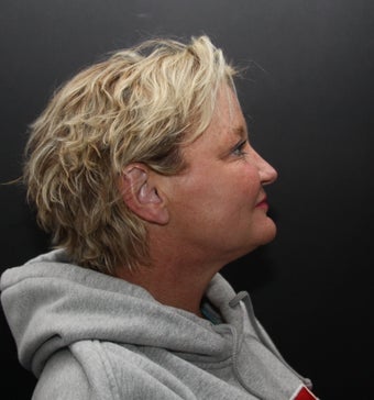 neck lift after 487225