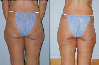 Butt Lift before 575369
