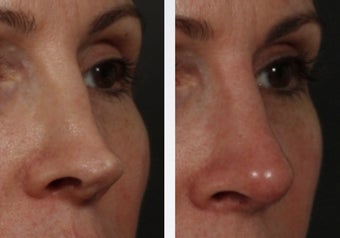 Revision Rhinoplasty before 358999