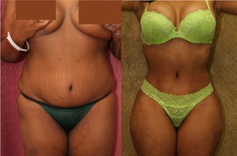 tummy tuck revision before 302681