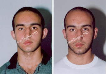 Ear Surgery - Otoplasty before 243388