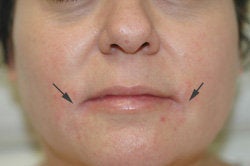 Restylane and Botox for mouth rejuvenation after 93349