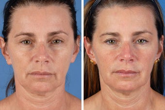 Radiesse & Botox Cosmetic before 356479