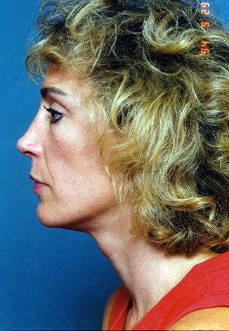 Revision Rhinoplasty before 540118
