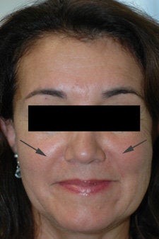 Restylane treatment for laugh lines after 91057